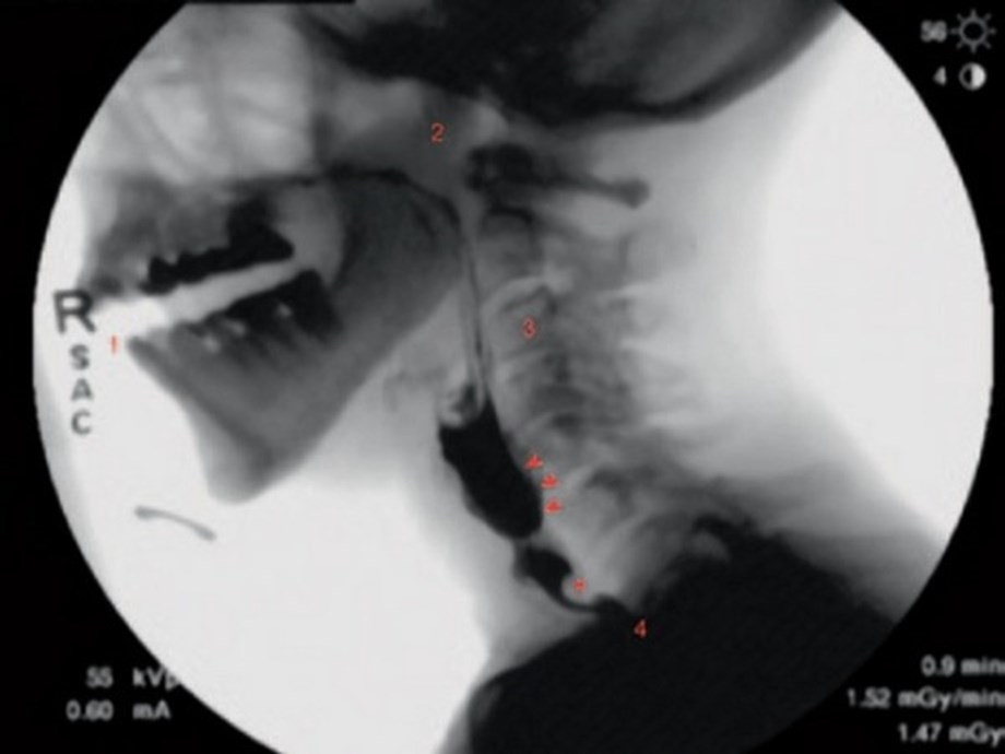 Research shows new guidelines set to standardize swallowing fluoroscopy Research shows new guidelines set to standardize swallowing fluoroscopy