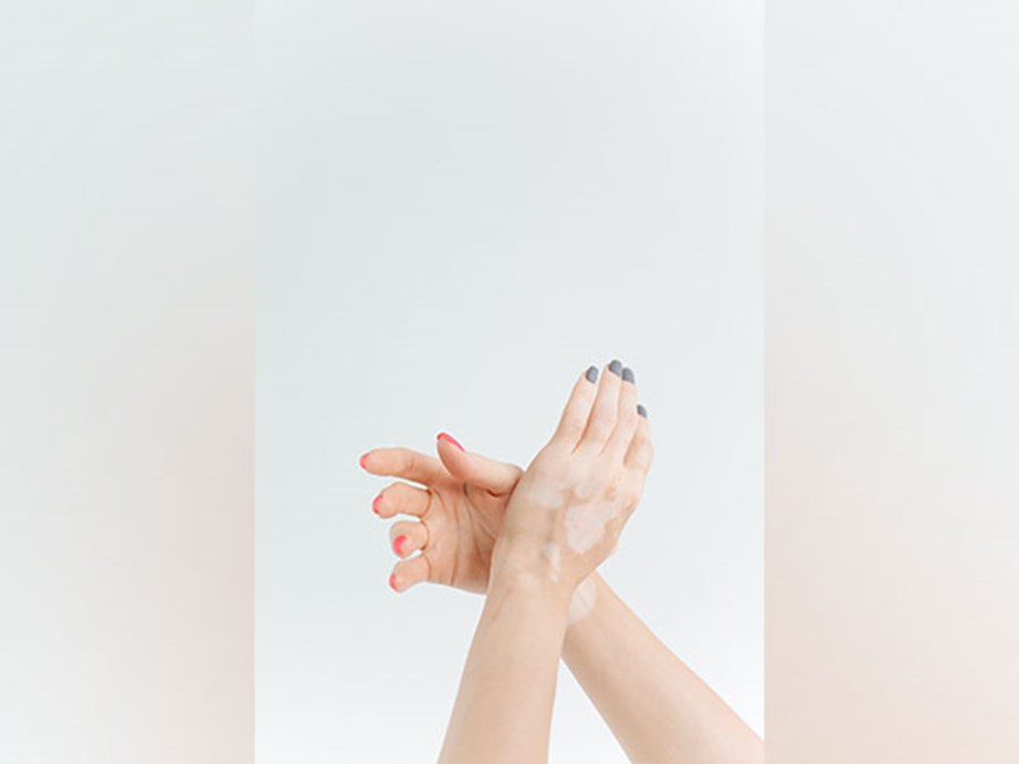 International Albinism Awareness Day today International Albinism Awareness Day today