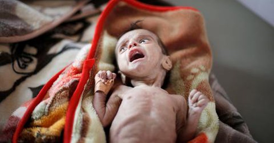 Image result for yemen famine
