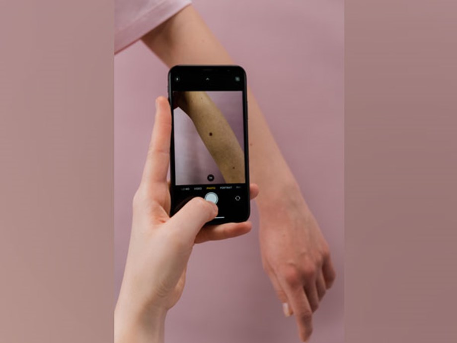 Researchers study why moles become melanomas Researchers study why moles become melanomas