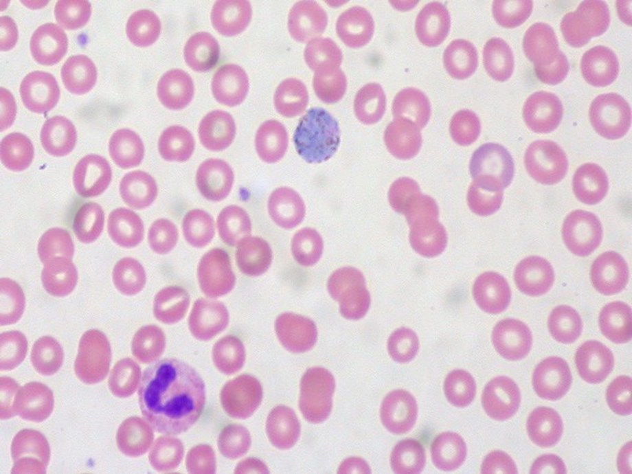 Blood clotting may be root cause of long COVID syndrome: Study Blood clotting may be root cause of long COVID syndrome: Study